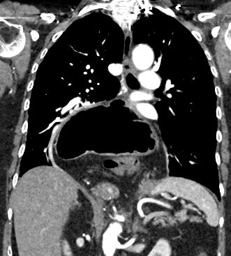 CT chest axial, coronal and sagittal images: Herniation of the