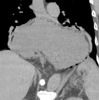 CT chest axial, coronal, and sagittal images: distended stomach