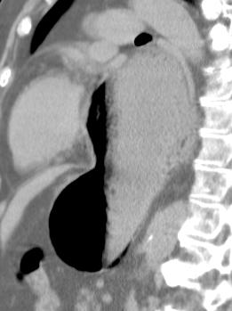 posterior mediastinum displacing heart (green arrows), and gastric