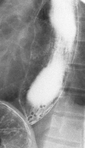 disease Dysphagia to solid and liquid, chest pain and regurgitation Usually diagnosed with manometry in early stage in suspected cases