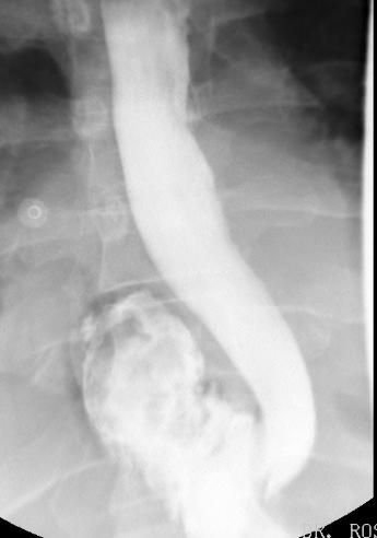 Boerhaave syndrome Imaging X-ray: May be normal, usually pneumomediastinum, left pleural