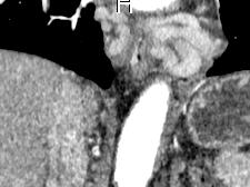 Esophageal Varices (EV) Dilated submucosal veins due to increased collateral blood flow from cirrhotic portal venous system to azygos system