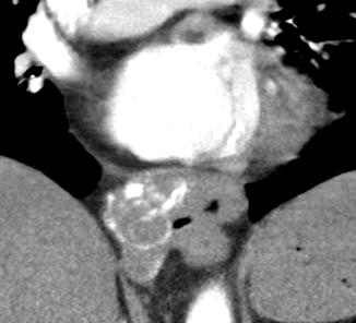 image : Lobulated soft tissue mass in GEJ