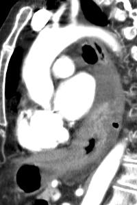 and peritoneal carcinomatosis with severe tense ascites CT/MRI: posterior mediastinal fluid