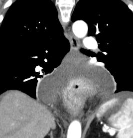 coronal, and sagittal images: abdominal ascites (yellow arrow) extended through the