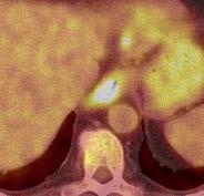 liver (green arrows) PET CT