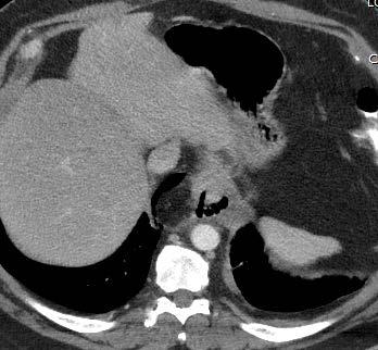 GEJ Adenocarcinoma with perforation CT chest axial, coronal, and sagittal images: