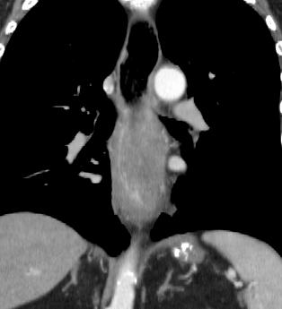 CT chest axial and coronal