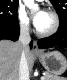 (yellow arrow) in a patient