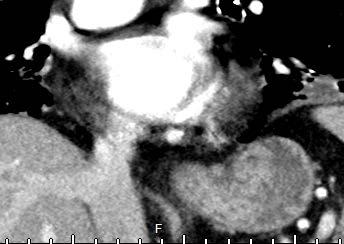 to this fissure, should raise the possibility of pseudo tumor Scans in left lateral decubitus or prone position would be