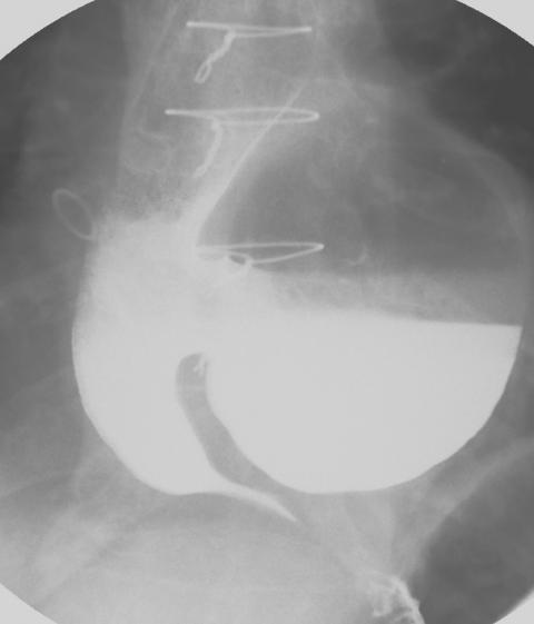 Epiphrenic esophageal Diverticulum Delay in diagnosis & treatment of ED can lead to severe