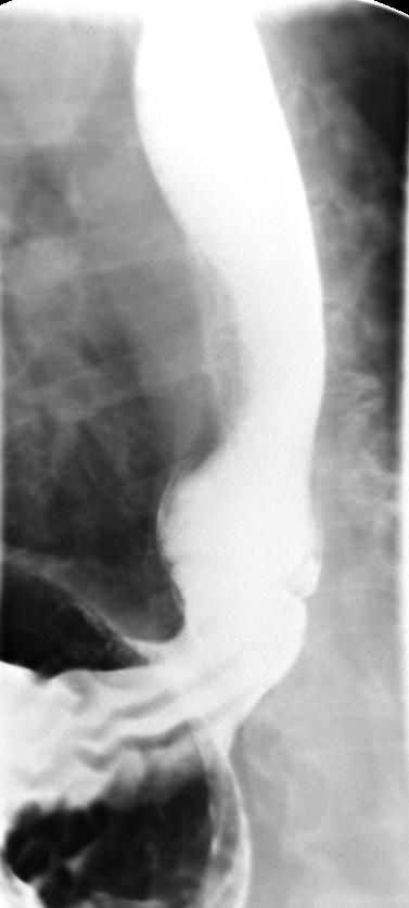 Type I (Sliding) hiatus hernia Most common (>90%) Esophageal hiatus is abnormally widened up to 3-4cm (normal: 1.