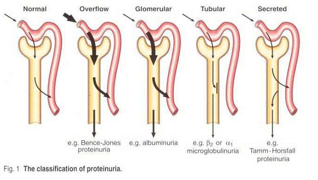 Types of proteinuria Glomerular proteinuria has higher levels of protein, often exceeding 2 g /day,mainly albumin Tubular proteinuria