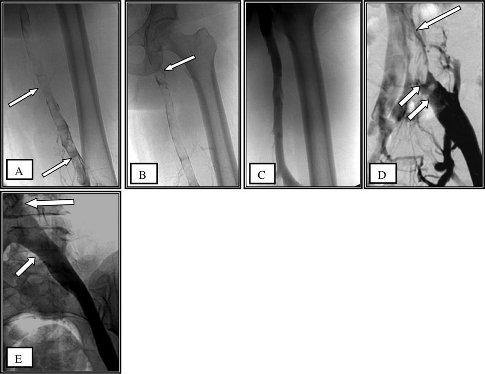 60 M. Gomaa et al. Figure 2 Complete lysis of the left popliteo-femoral thrombus that extends up to the IVC in a 48 year old female patient.