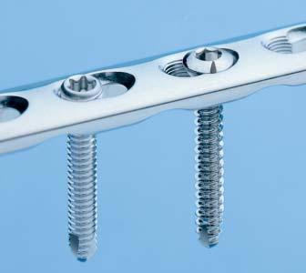 The Synthes Locking Compression Plate (LCP) is part of a stainless steel and titanium plate and screw system that merges locking screw technology with conventional plating techniques.