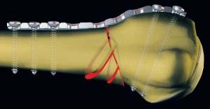 The developing friction (F3) between the plate and the bone leads to stable plate fixation.