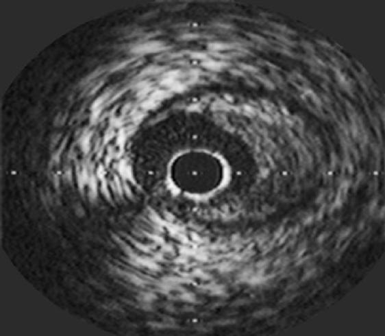 LDL-C and Atherosclerosis in IVUS* Studies Interventional Studies Have Shown Linear Relationship Between LDL-C, and Atherosclerosis Progression Median Chamge in percent Atheroma Volume (%) 1.8 1.2 0.