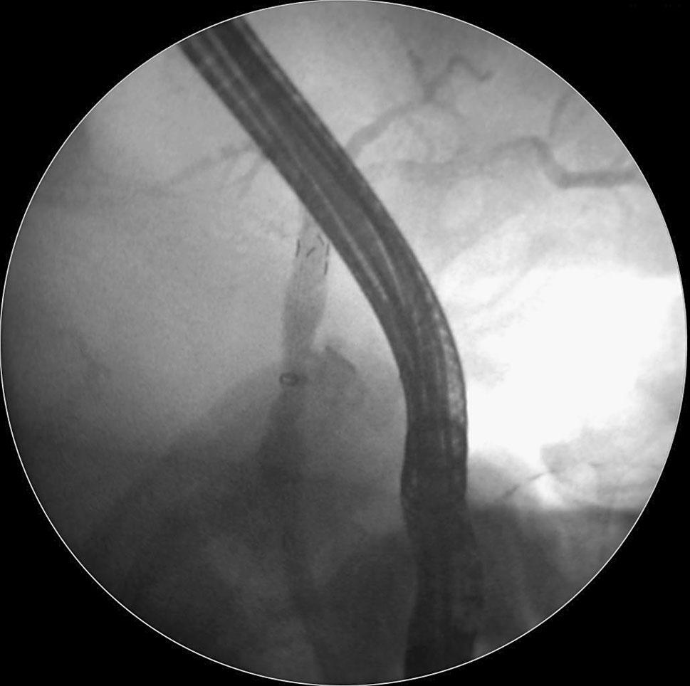 Fig. 3 Placement of Hanaro biliary fully covered, removable metal stent placement, which was easily controlled with administration of non-steroidal anti-inflammatory drugs.