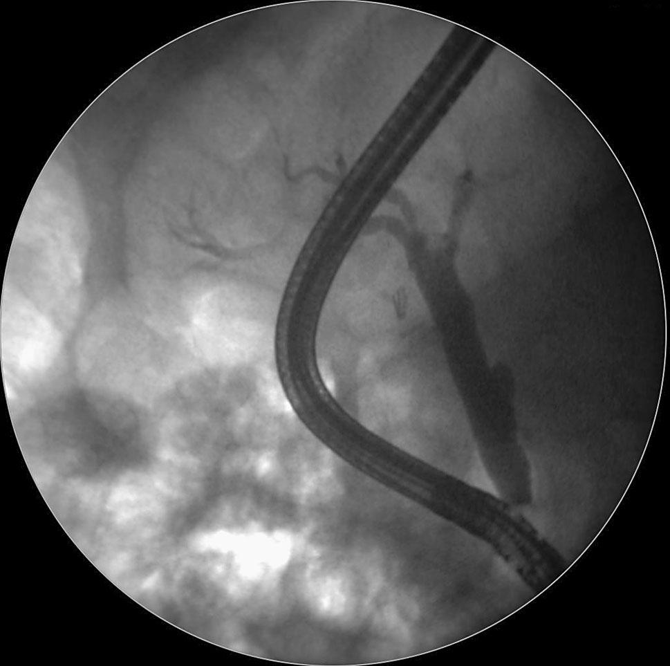 Thirty-two stents were placed, but only 30 were removed (93.7 %).