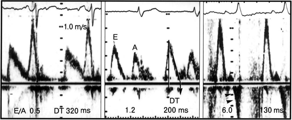 PW Doppler of mitral inflow velocities from predominant relaxation abnormality (left), normal or