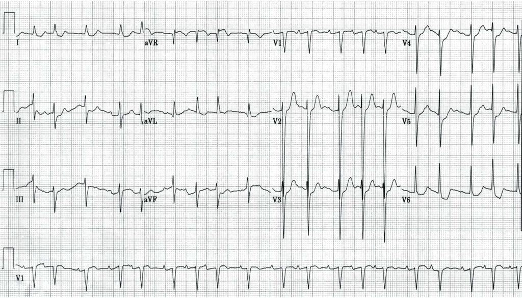 Multifocal Atrial Tachycardia Kusumoto, ECG Interpretation: from