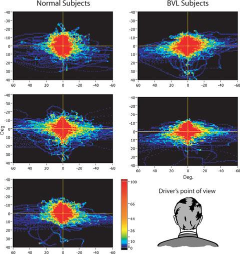 MacDougall et al.: Driving Performance in Bilateral Vestibular-Deficient Patients 415 Figure 2.