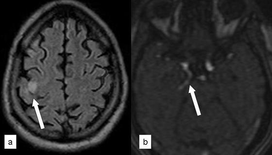 (b) Axial MRA image shows fetal  Fig-10: (a &b) Axial T2 FLAIR and