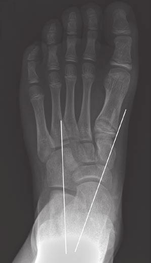 Radiography of Pediatric Foot lignment shafts of the metatarsals are of no consequence. It is their relationship to the bases that are important.