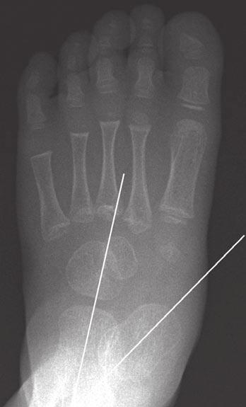 Thapa et al. Scenario 2 2-year-old boy presented with a foot deformity and some skin changes at the medial aspect of the talar head.
