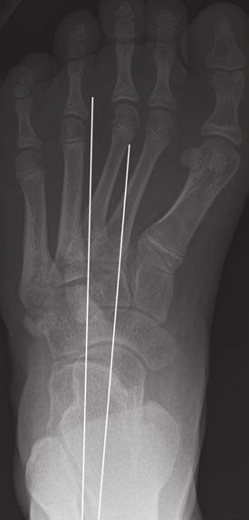 Radiography of Pediatric Foot lignment Scenario 4 3-year-old boy with foot deformity whose parents claim, the top of the foot is where the bottom should be.