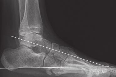 On the anteroposterior projection, note the near parallel alignment of the talus and calcaneus, making the talocalcaneal angle very acute or nonexistent. In the forefoot, there is adduction.