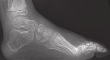 The lateral view of the forefoot also shows a ladderlike arrangement of the metatarsals, with the fifth metatarsal corresponding to the lowest rung of the ladder.