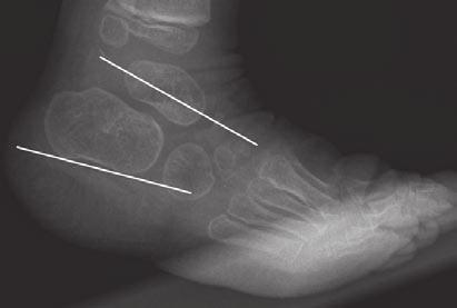 Thapa et al. Scenario 5 9-year-old boy presented with medial foot pain. Figure 5 shows hindfoot and forefoot alignment abnormalities. In the 9-year-old boy, weightbearing anteroposterior (Fig.