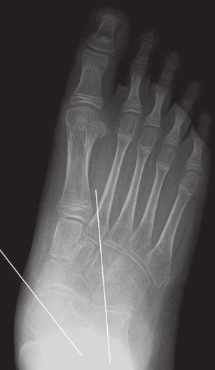 Radiography of Pediatric Foot lignment Fig. 5 Children with medial foot pain, one with history of cerebral palsy.