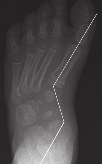 Thapa et al. References 1. Ozonoff M. The foot. In: Ozonoff M, ed. Pediatric orthopedic radiology. Philadelphia, P: Saunders, 1992:397 460 2. Harty MP. Imaging of pediatric foot disorders.