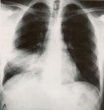 (RML) Lobar Pneumonia Mettler, FA ( 1996). Essentials of Radiology.