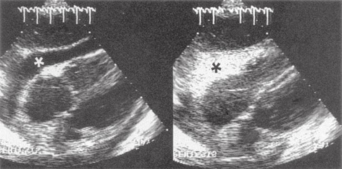 pericardial disease: etiology, pathophysiology, clinical recognition, and treatment 1493 neously. Superior quality tracings are obtained when two multipurpose catheters are used.
