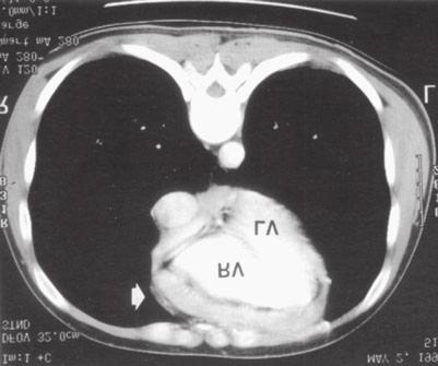This abnormality does not differentiate between restrictive cardiomyopathy and constrictive pericarditis.