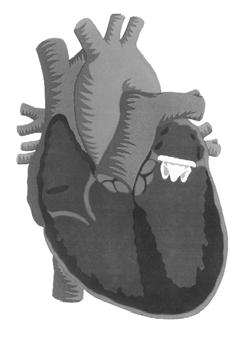 Mosaic Aortic Valve Mosaic Mitral Valve Where does the surgeon place the Mosaic valve? The illustration above shows where a Mosaic valve may be placed within the heart to help it pump efficiently.