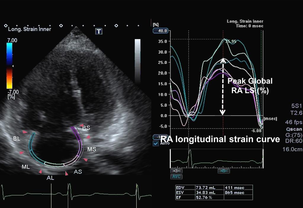 32 J Echocardiogr (2016) 14:30 38 interest, longitudinal strain curves were generated for each atrial segment by the software. RA longitudinal strain (RALS) was measured in six segments of the RA.