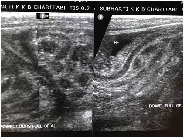 2 Ultrasound abdomen showing bowel loops full of worms looking