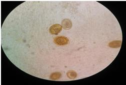 Fig.3 Wet mount of stool sample showing abundant of both fertilized and unfertilized eggs of Ascaris lumbricoides (x40) Infection due to Ascaris lumbricoides have variable clinical features ranging