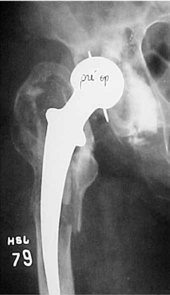 CIRCUMFERENTIAL PROXIMAL FEMORAL ALLOGRAFTS IN REVISION SURGERY ON TOTAL HIP ARTHROPLASTY: CASE REPORTS WITH A MINIMUM FOLLOW-UP OF 20 YEARS 385 tion of the cemented acetabular component.