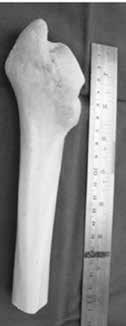 Proximal migration of the greater trochanter had occurred, and there was a comminuted periprosthetic fracture at the level of the prosthesis.