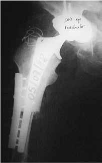 The patient underwent THA revision, consisting of revision of the cemented acetabular component by means of an uncemented implant, and use of a non-irradiated circumferential allograft from the