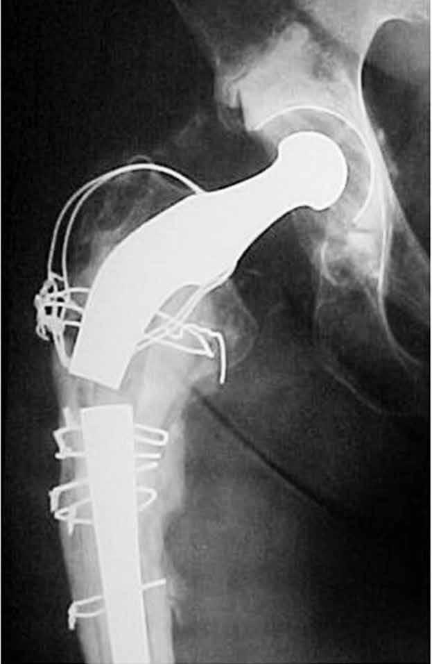 386 A B femoral implant (Charnley prosthesis) was observed, associated with severe bone deficiency in the proximal third of the femur, thus characterizing a