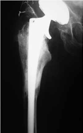 -irradiated circumferential allograft from the proximal femur and a cemented femoral component, in association with stabilization of the graft with a plate