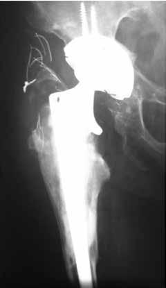 Radiographically, it was observed that the implant was stable, with graft reabsorption in Gruen zone II (6).