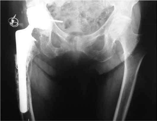 CIRCUMFERENTIAL PROXIMAL FEMORAL ALLOGRAFTS IN REVISION SURGERY ON TOTAL HIP ARTHROPLASTY: CASE REPORTS WITH A MINIMUM FOLLOW-UP OF 20 YEARS 387 After 20 years of postoperative follow-up, the patient