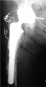 Twenty-one years after the surgical procedure, the patient died due to worsening of her clinical condition. A B C Figure 6 (A) Radiograph produced during immediate postoperative period.